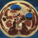 Cryosection du Visible Human avec muscles, côtes, vertèbres, reins, intestin grêle, gros intestin et foie (détail, vue crâniale)