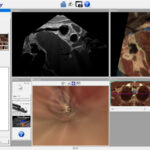 Visualisation de l'arc aortique par échographie endoscopique (EUS)