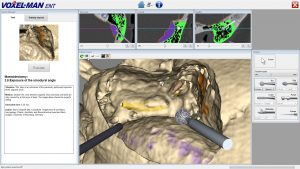 Mastoïdectomie virtuelle avec VOXEL-MAN Tempo